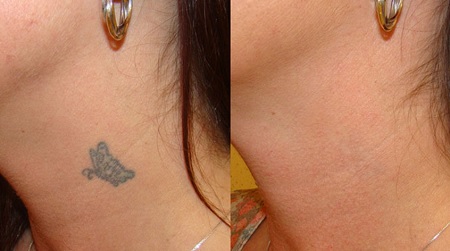 Las 5 mejores clínicas para eliminar tatuajes en Granada