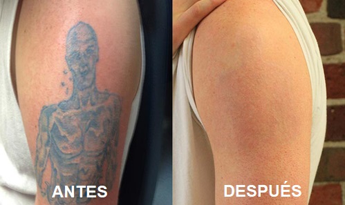 Los mejores 5 centros para eliminar tatuajes en Murcia