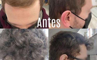 Trasplante capilar en Madrid, ¿Dónde hacerse un injerto de pelo? Las 5 mejores clínicas
